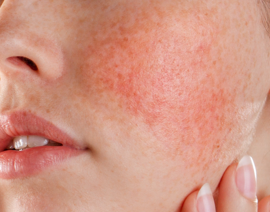 Hình ảnh: da nhạy cảm giao mùa